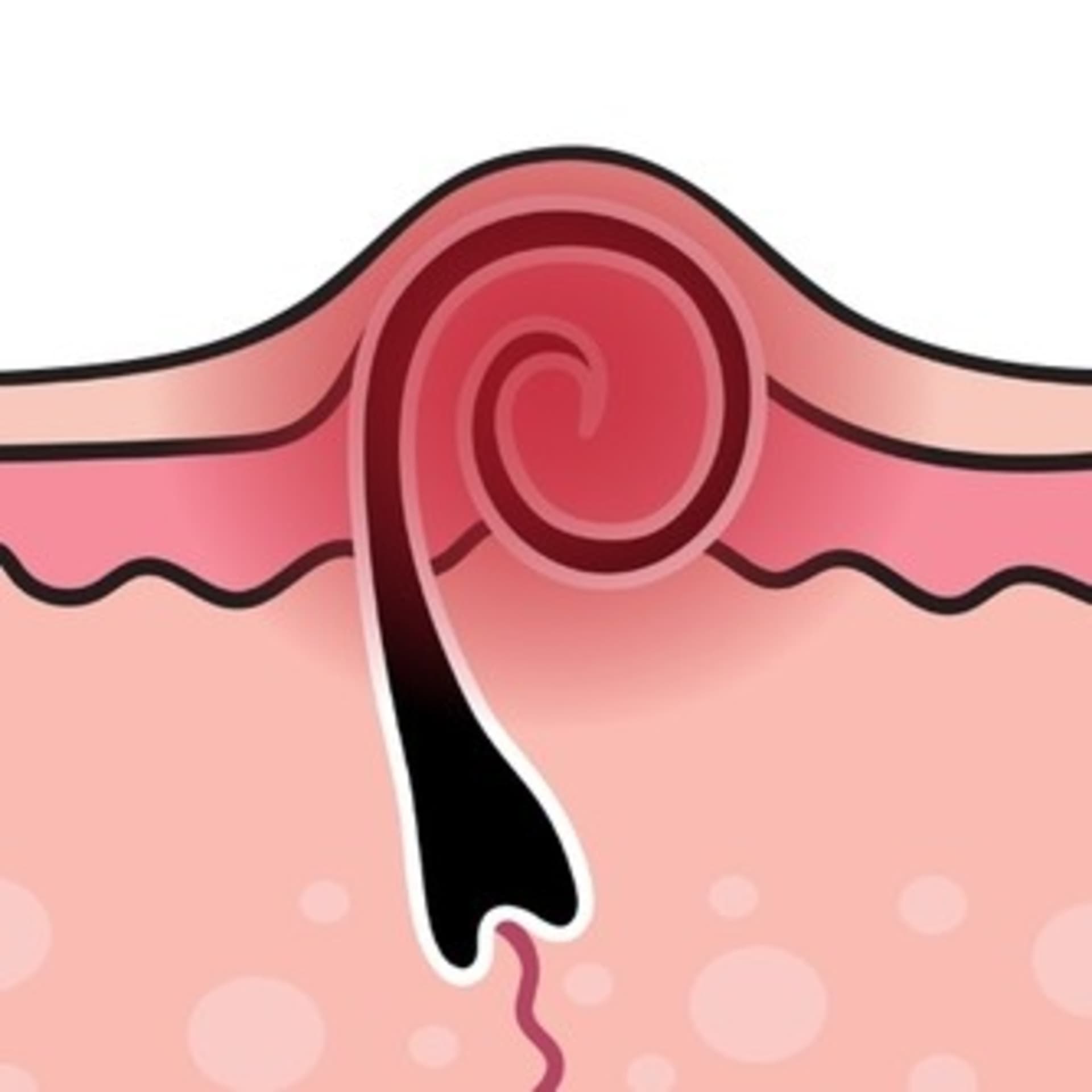 Pêlo Encravado Na Virilha - Podcasts